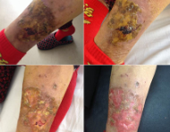 威伐光治疗湿疹继发感染的治疗