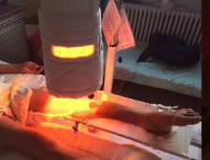 威伐光挽救残疾，避免截肢---来自粉碎性骨折患者的自述